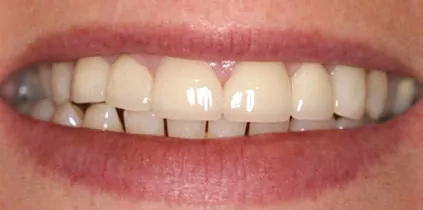 Actual-Patient - After