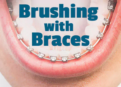 Brushing-With-Braces-Adults